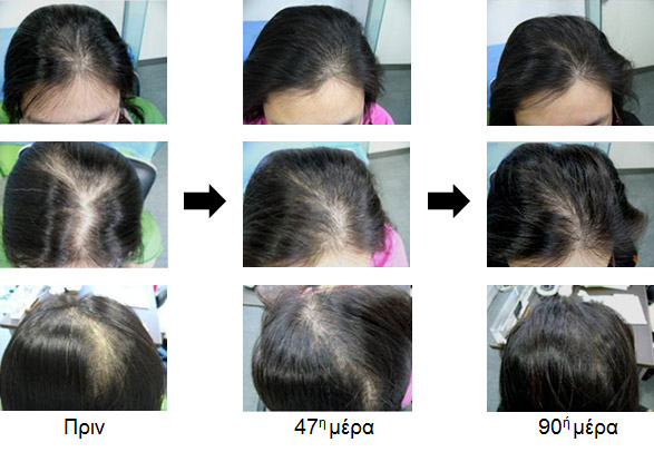 Περίπτωση 1. Γυναίκα 32 ετών